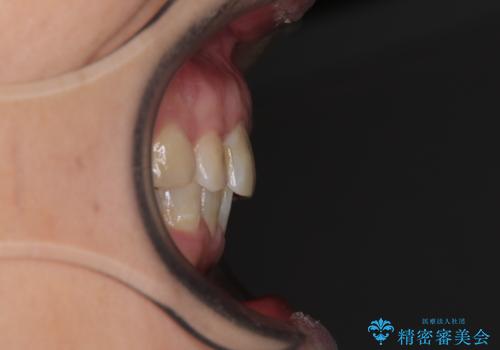 ハーフリンガルで歯列をきれいに セラミック治療で気になる銀歯も自然な色にの治療後