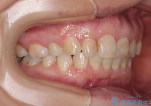 ハーフリンガルで歯列をきれいに セラミック治療で気になる銀歯も自然な色にの治療後