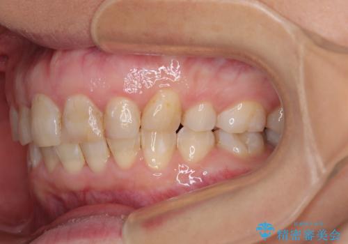 ハーフリンガルで歯列をきれいに セラミック治療で気になる銀歯も自然な色にの治療後