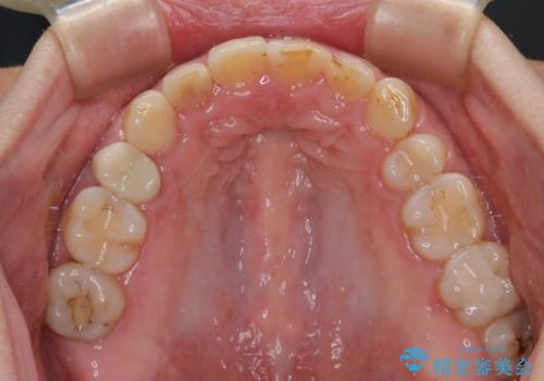 ハーフリンガルで歯列をきれいに　セラミック治療で気になる銀歯も自然な色にの治療後