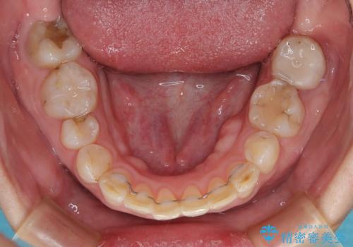 ハーフリンガルで歯列をきれいに　セラミック治療で気になる銀歯も自然な色にの治療後