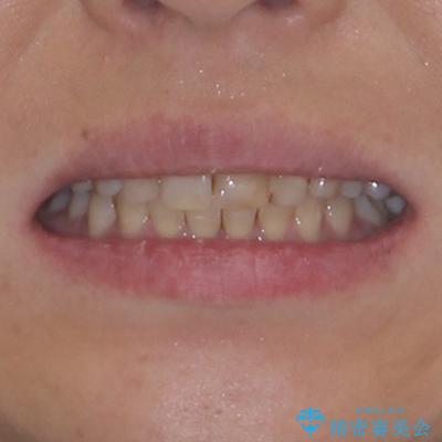 ハーフリンガルで歯列をきれいに　セラミック治療で気になる銀歯も自然な色にの治療後（顔貌）