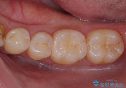 奥歯がしみる　保険の詰め物をセラミックインレーにの症例 治療前