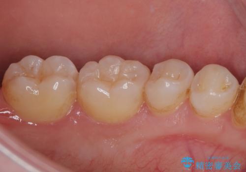奥歯がしみる 保険の詰め物をセラミックインレーにの治療前