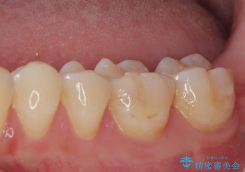 奥歯がしみる 保険の詰め物をセラミックインレーにの治療前