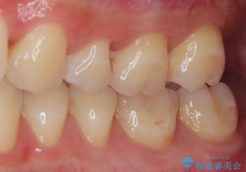 奥歯がしみる 保険の詰め物をセラミックインレーにの治療前