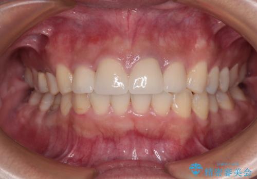 歯列から飛び出た歯　ワイヤー矯正で整った歯列にの症例 治療後