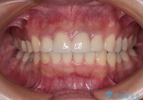 歯列から飛び出た歯　ワイヤー矯正で整った歯列に