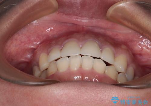歯列から飛び出た歯 ワイヤー矯正で整った歯列にの治療後
