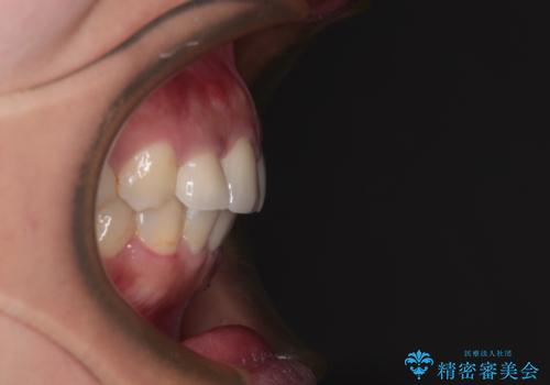 歯列から飛び出た歯　ワイヤー矯正で整った歯列にの治療後