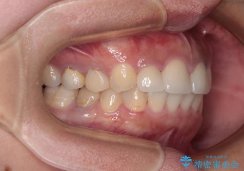 歯列から飛び出た歯 ワイヤー矯正で整った歯列にの治療後