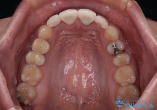 歯列から飛び出た歯 ワイヤー矯正で整った歯列にの治療後