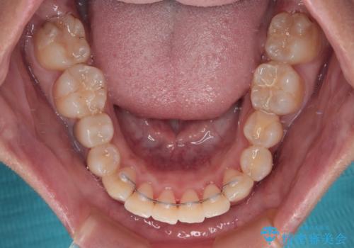 歯列から飛び出た歯　ワイヤー矯正で整った歯列にの治療後