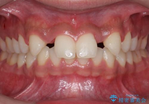 前歯のすきま 生まれつき歯が少ないのを治療の治療中