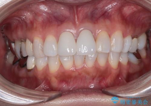 色の不釣り合いな前歯　オールセラミッククラウンで調和の取れた前歯にの治療後