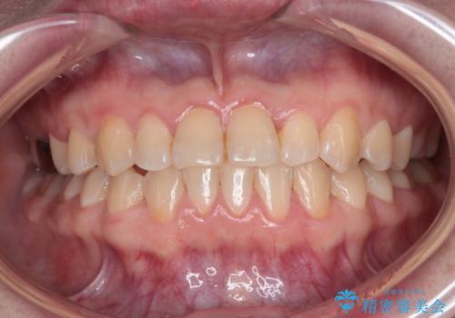 反対咬合を治したい ワイヤー装置で一気に咬み合わせを改善の治療後