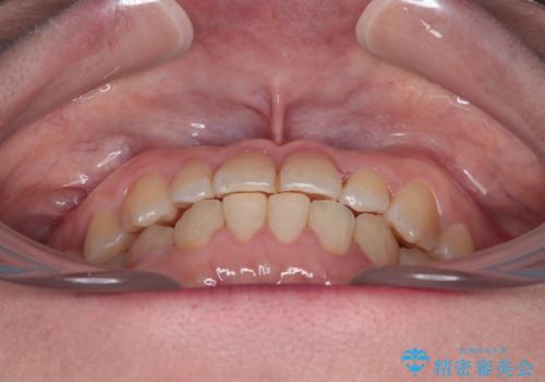 反対咬合を治したい ワイヤー装置で一気に咬み合わせを改善の治療後