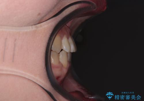 反対咬合を治したい ワイヤー装置で一気に咬み合わせを改善の治療後