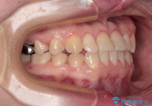 反対咬合を治したい ワイヤー装置で一気に咬み合わせを改善の治療後