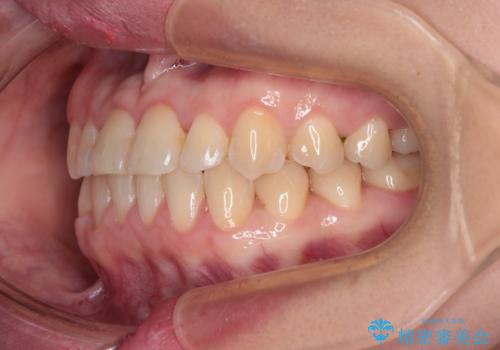 反対咬合を治したい ワイヤー装置で一気に咬み合わせを改善の治療後