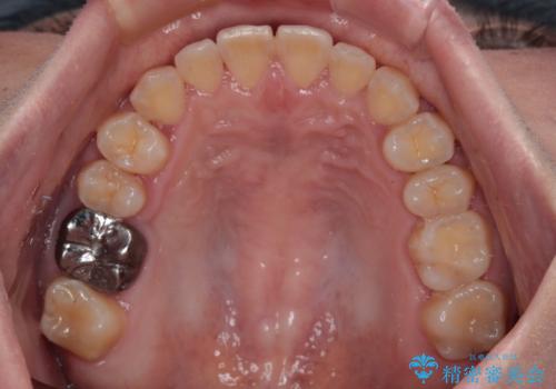 反対咬合を治したい ワイヤー装置で一気に咬み合わせを改善の治療後