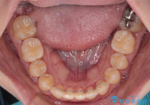 反対咬合を治したい ワイヤー装置で一気に咬み合わせを改善の治療後