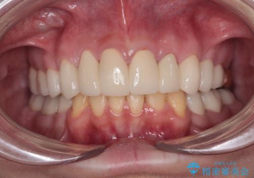 酸蝕歯でボロボロの歯の審美歯科治療　矯正治療も併用して、美しい口元への症例 治療後