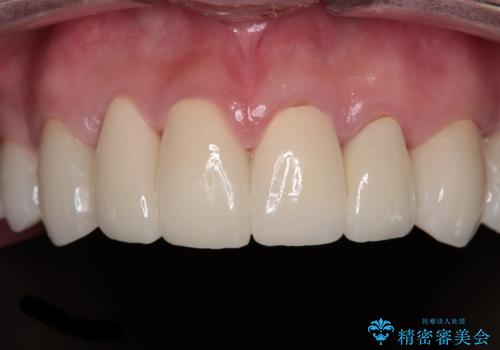 酸蝕歯でボロボロの歯の審美歯科治療　矯正治療も併用して、美しい口元への治療後