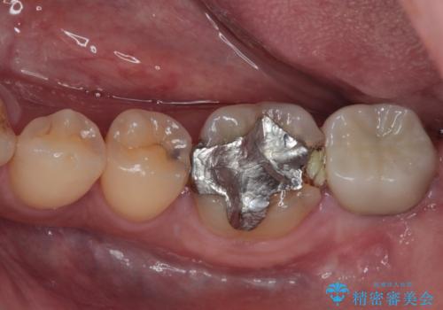 銀歯の周りから進行したむし歯　欠けてしまった歯をオールセラミッククラウンにの症例 治療前