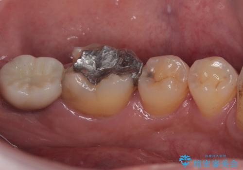 銀歯の周りから進行したむし歯　欠けてしまった歯をオールセラミッククラウンにの治療前