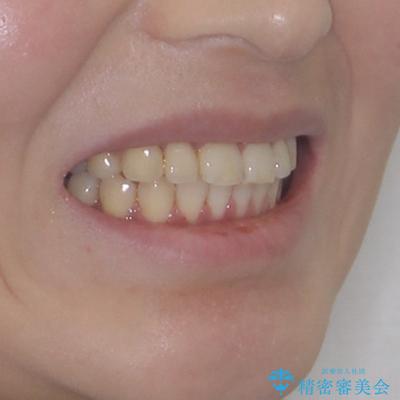 飛び出した前歯を引っ込めたい ワイヤー装置での抜歯矯正の治療後(顔貌)