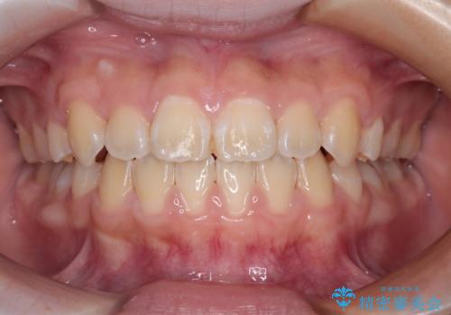 舌突出癖で出っ歯と開咬に　舌のトレーニングを行いながら抜歯矯正　の症例 治療後