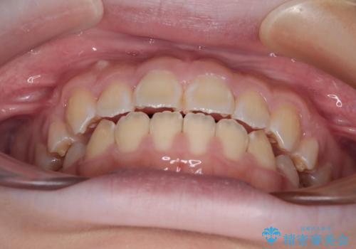 舌突出癖で出っ歯と開咬に 舌のトレーニングを行いながら抜歯矯正 の治療後