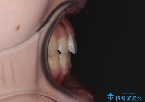 舌突出癖で出っ歯と開咬に 舌のトレーニングを行いながら抜歯矯正 の治療後