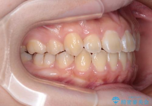 舌突出癖で出っ歯と開咬に 舌のトレーニングを行いながら抜歯矯正 の治療後