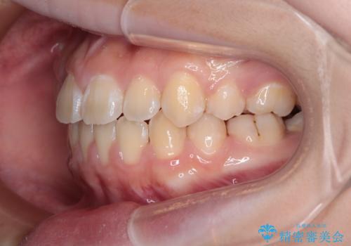 舌突出癖で出っ歯と開咬に　舌のトレーニングを行いながら抜歯矯正　の治療後