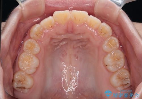 舌突出癖で出っ歯と開咬に 舌のトレーニングを行いながら抜歯矯正 の治療後