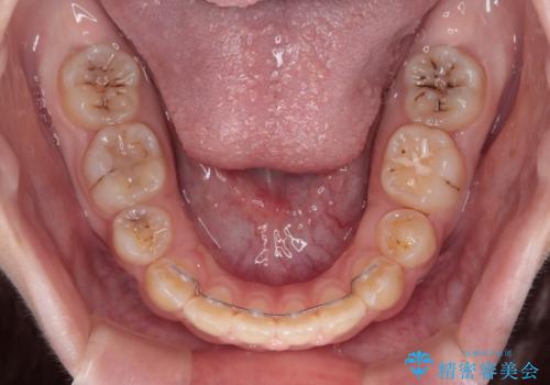 舌突出癖で出っ歯と開咬に　舌のトレーニングを行いながら抜歯矯正　の治療後