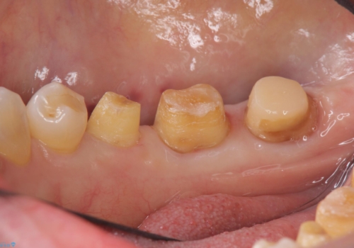 奥歯の高さがない　歯周外科で解決の治療中