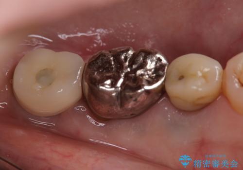 毎食後物がつまる! インプラント治療の症例 治療後