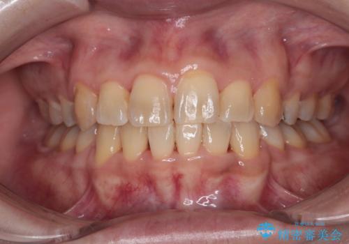 治療途中で帰国 装置をつけた状態を継続して矯正治療の治療後