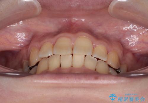 治療途中で帰国 装置をつけた状態を継続して矯正治療の治療後