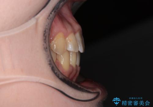 治療途中で帰国 装置をつけた状態を継続して矯正治療の治療後