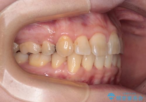 治療途中で帰国 装置をつけた状態を継続して矯正治療の治療後