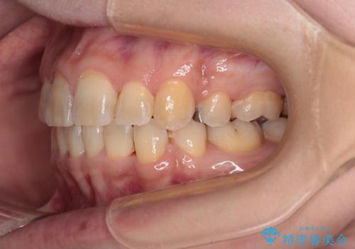 治療途中で帰国 装置をつけた状態を継続して矯正治療の治療後