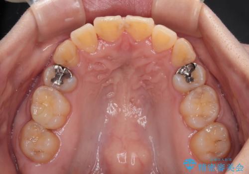 治療途中で帰国 装置をつけた状態を継続して矯正治療の治療後