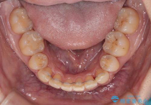 治療途中で帰国 装置をつけた状態を継続して矯正治療の治療後