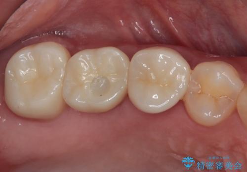 壊れやすいブリッジ インプラント治療で安定した咬み合わせにの症例 治療後