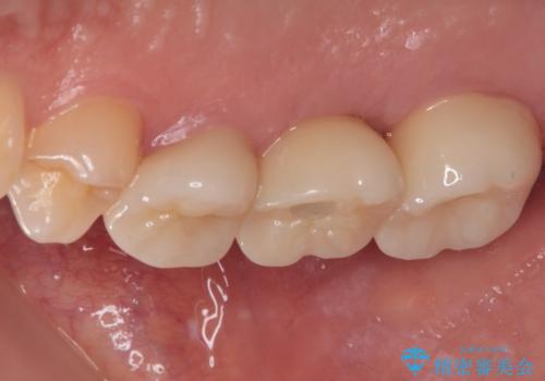 壊れやすいブリッジ インプラント治療で安定した咬み合わせにの治療後