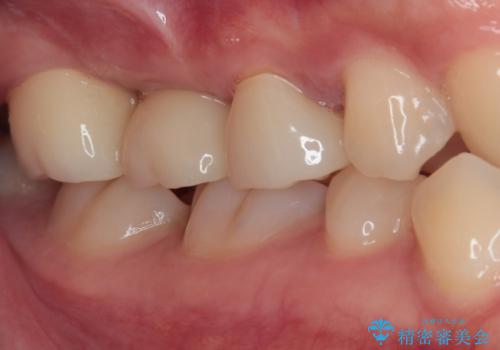 壊れやすいブリッジ インプラント治療で安定した咬み合わせにの治療後